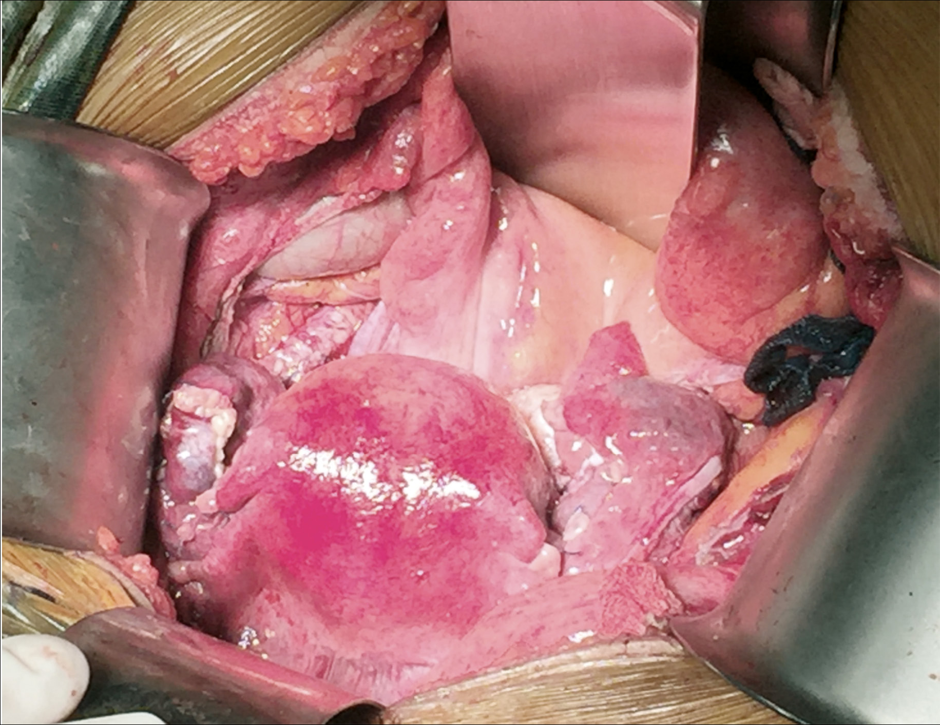 髂外静脉和供体阴道残端缝合到受体阴道的子宫血管吻合图示意图